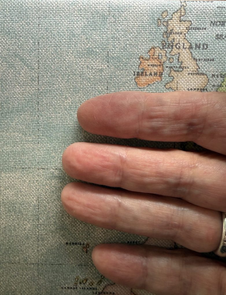 Close-up of fingers with virtually no fingerprint ridges resting on map patterned fabric