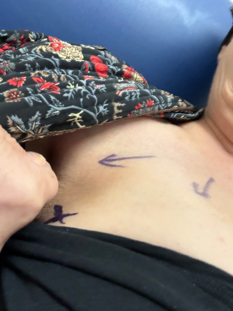 img_2283 Close-up of a person’s upper chest with purple marker markings beside floral fabric